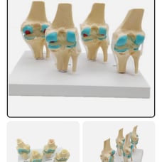Four-stage Human Pathological Knee Joint Anatomy Model Medical Science Teaching