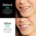 Evertone Teeth Whitening Kit with LED light
